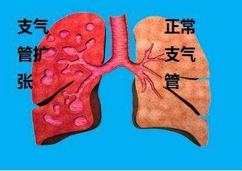 若患者的病情比較嚴重,會發生反覆的肺部感染,不停的咳嗽,會有大量膿