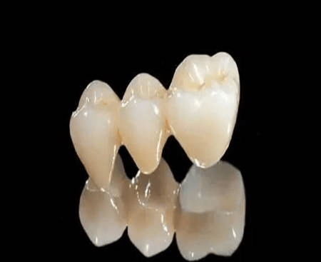 有一种补牙叫嵌体修复