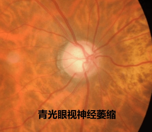 全国爱眼日眼底一张照眼病早知道这家三甲医院有免费眼底照相检查