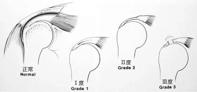 肩袖损伤分级图片