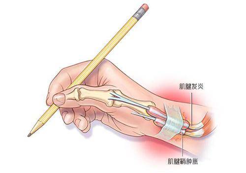 肌腱炎採用ble低頻神經肌肉治療儀進行理療,該方法可取嗎?