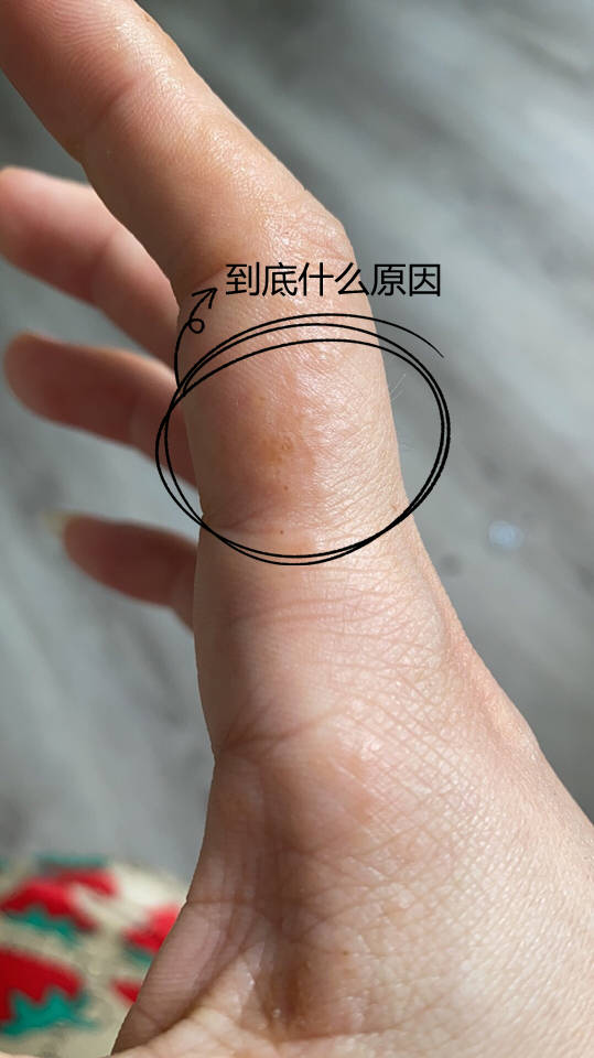 手掌手指起小水泡起痒医生4类食物