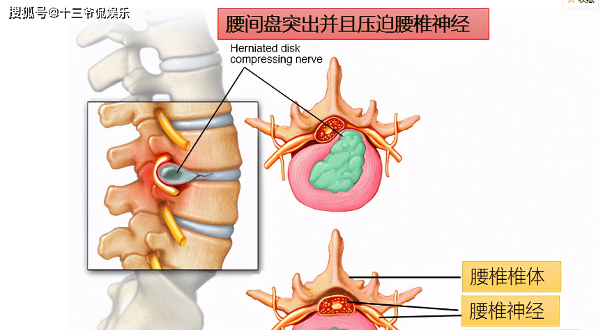 腰椎间盘突出要采用什么方法治疗好 我想问下你的腰椎间盘