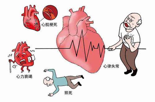 3,心包炎:心包炎可分為急性心包炎,慢性心包炎,縮窄性心包炎,患者可有