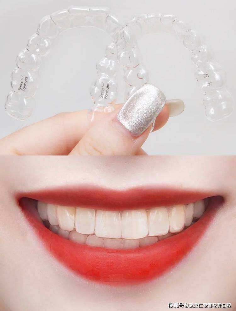 不管你承不承认隐形牙套就是牙套界爱马仕