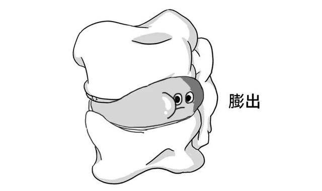 腰椎间盘轻度膨出怎么办