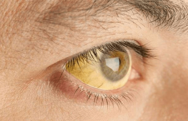 肝脏|身体出现“1大1黄1痒”，提醒你注意：或是肝脏的“求救”信号