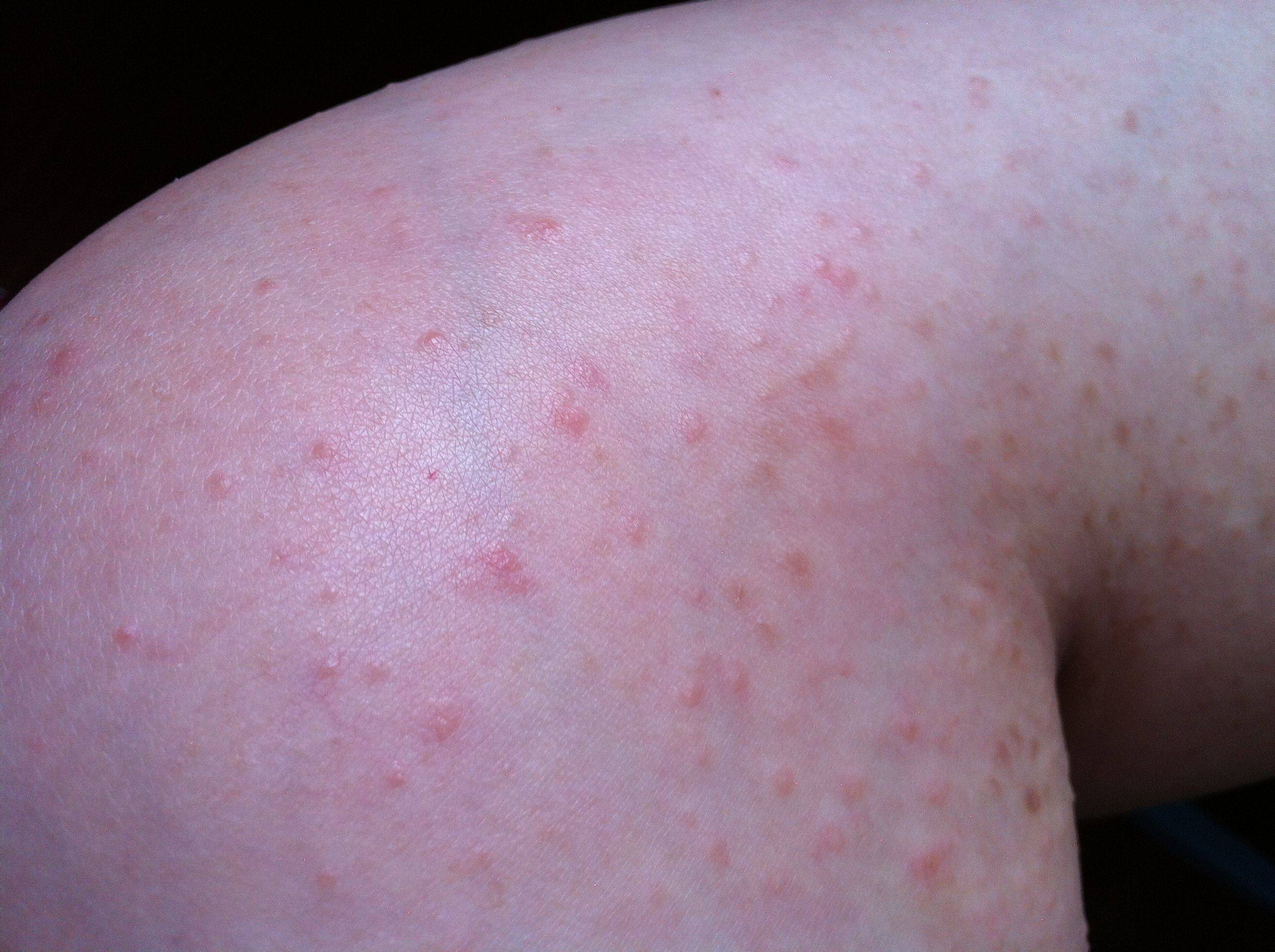 湿疹的症状 初期图片