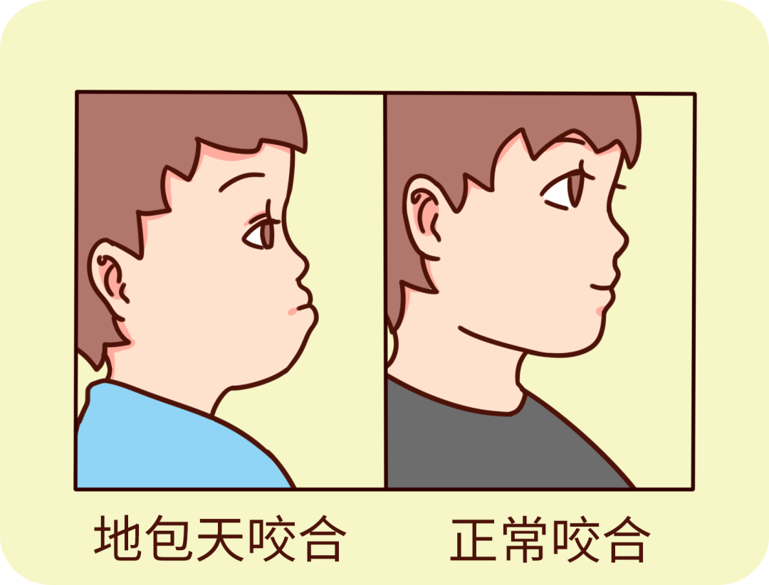 孩子长了双排牙,容易形成"地包天",下颌和脸型会出现一定的变形;而且