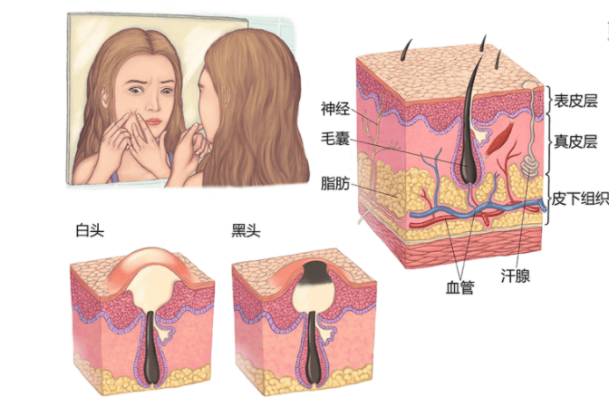 吴锦威|吴锦威老师：为什么你脸上痘痘反反复复？