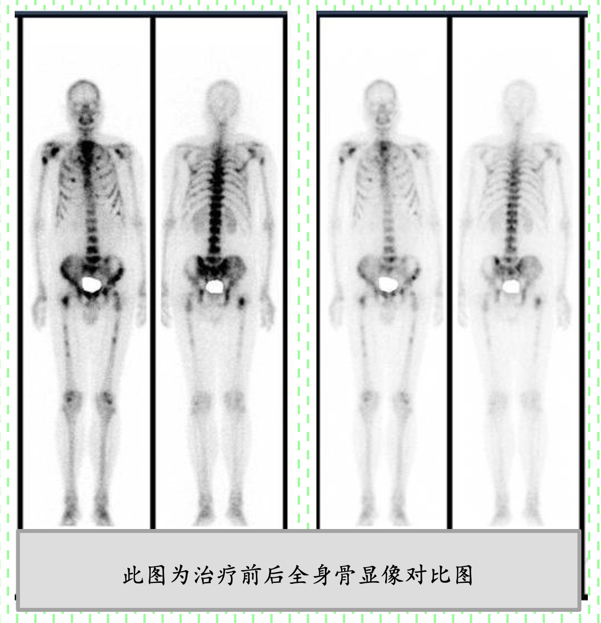 患者进行氯化锶[89sr]治疗前需进行严格的临床评估和筛选