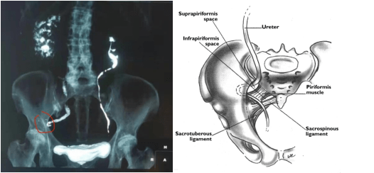 输尿管|这疝实属罕见！天津市人民医院成功为输尿管坐骨大孔疝患者实施腹腔镜微创术