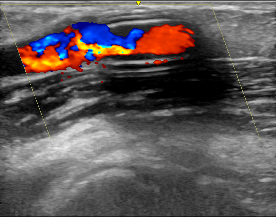 覆膜|肾脏内科实施陕西省首例超声引导下透析通路支架植入术