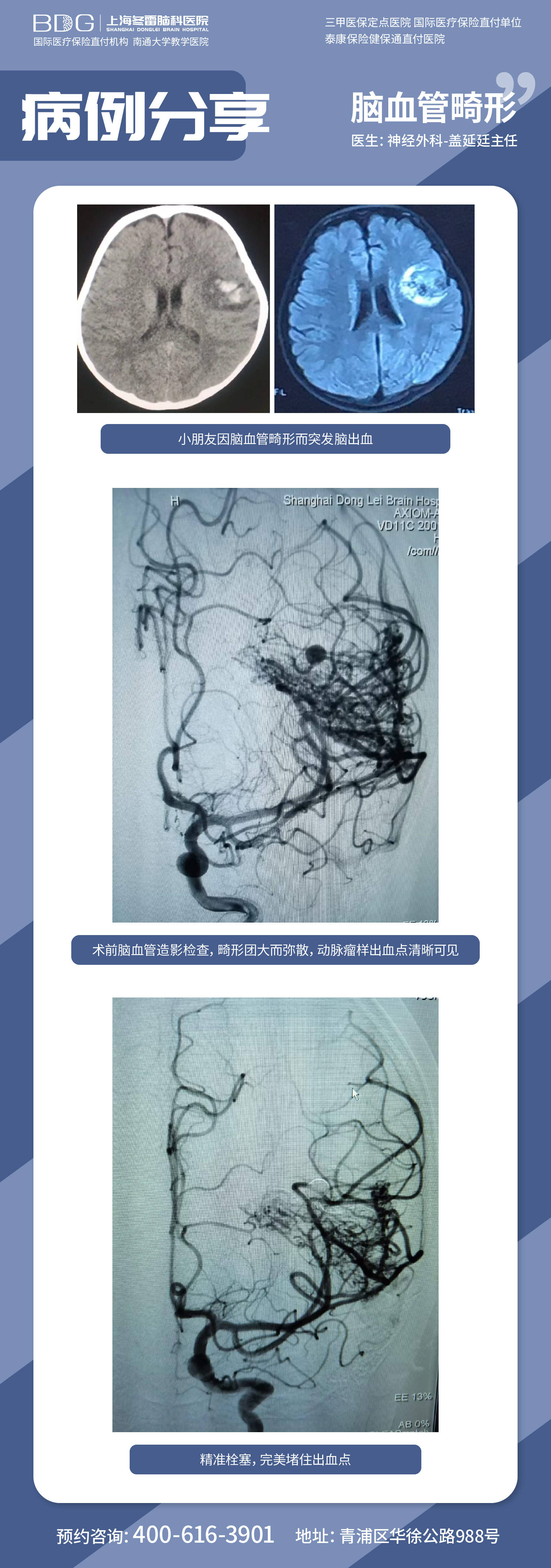 上海冬雷脑科医院盖延廷主任微创治疗脑血管畸形