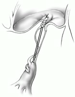 治疗|反复发烧2个多月，17岁女孩患的这种少见病经高难手术精巧治愈