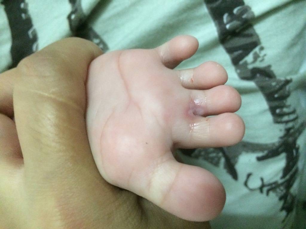 婴儿脚气该如何预防?