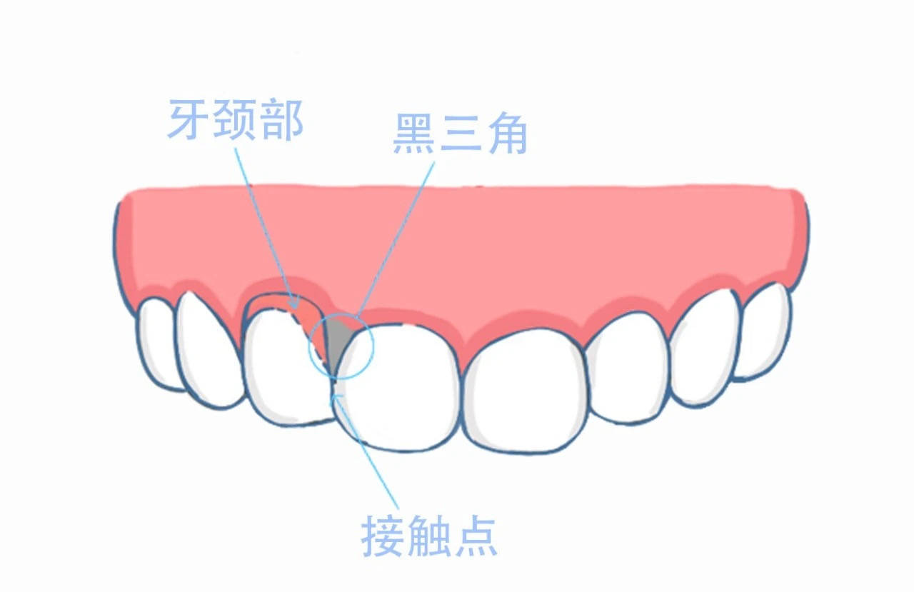 拿什么拯救你牙齿黑三角