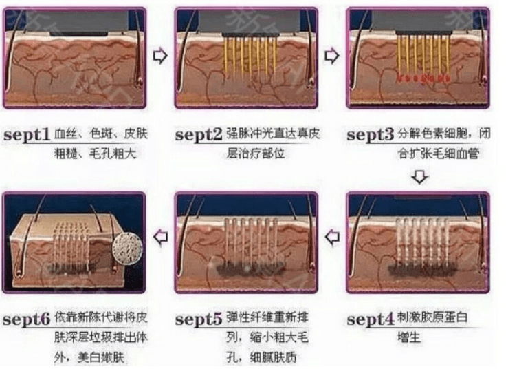 什么|做光子嫩肤的仪器有哪些？