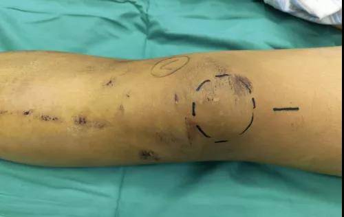 手术|小伙骑车摔倒粉碎性骨折，三中心“髌上入路髓内钉”手术让小伙转危为安