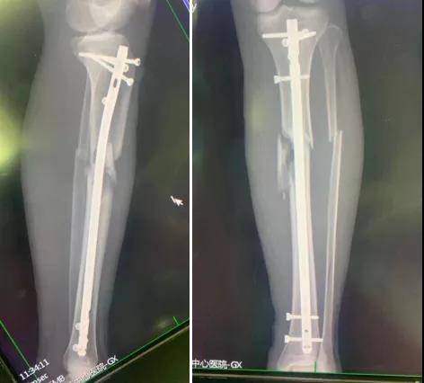 手术|小伙骑车摔倒粉碎性骨折，三中心“髌上入路髓内钉”手术让小伙转危为安