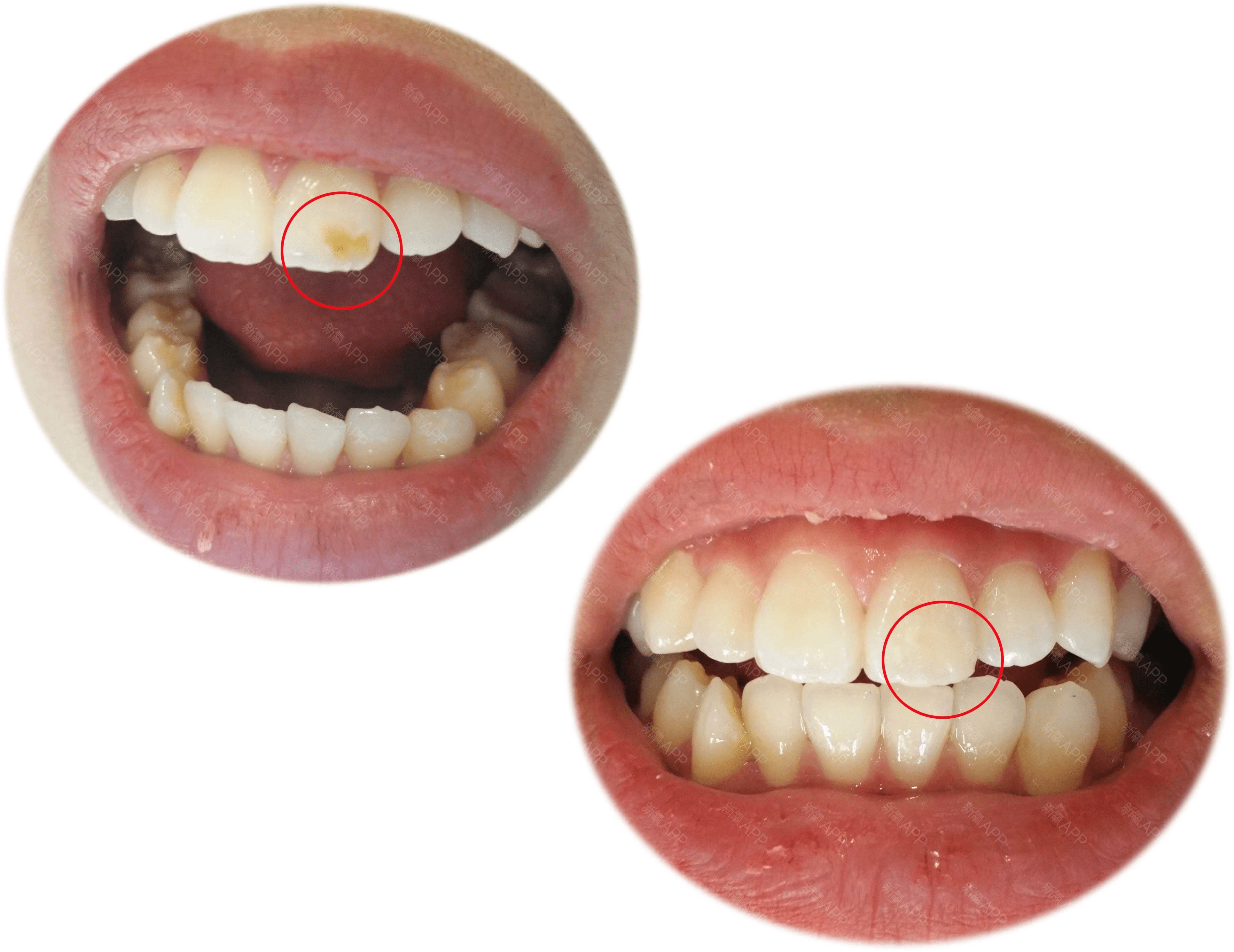 蛀牙可以恢复小窍门口腔师总结5个预防妙招
