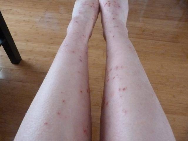 哪些治疗湿疹方法有效果好一些