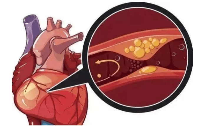 留意心梗的常见表现_冠状动脉