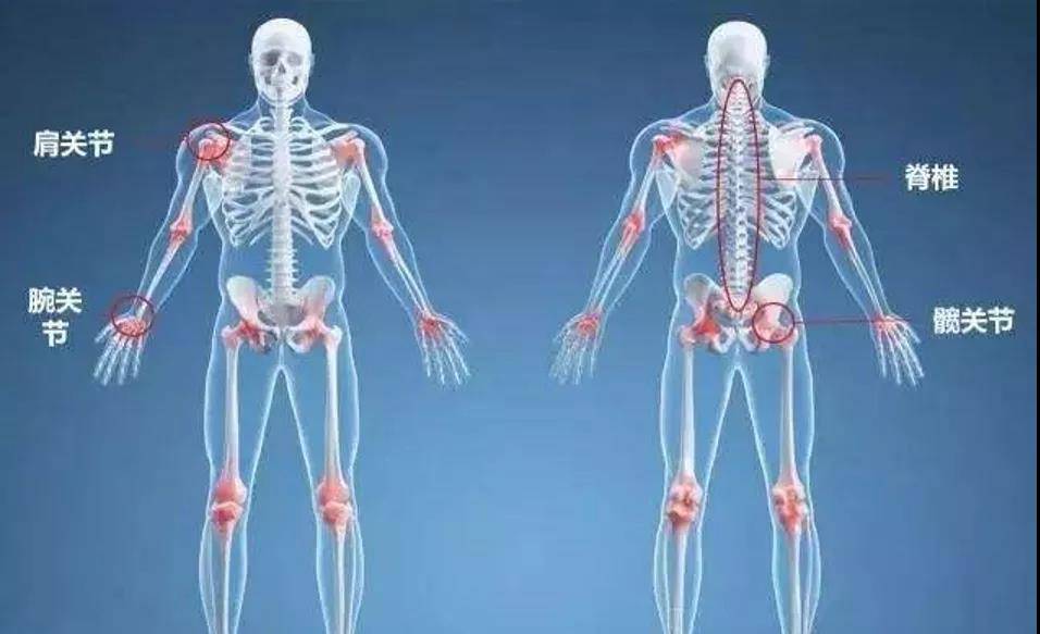 常见的骨折部位包括脊柱,髋部,尺桡骨远端(手腕)和肱骨近端(大臂)