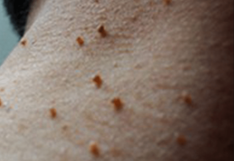 16岁男生背上总是冒"痘",竟是hpv感染导致,医生指出原因令人惊讶_病毒