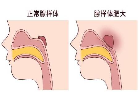 首大石萍腺樣體肥大能不能保守治療