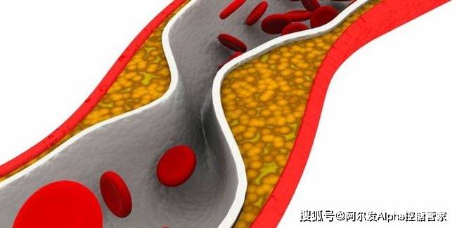 症状|关于糖尿病,还有哪些是你不知道的?