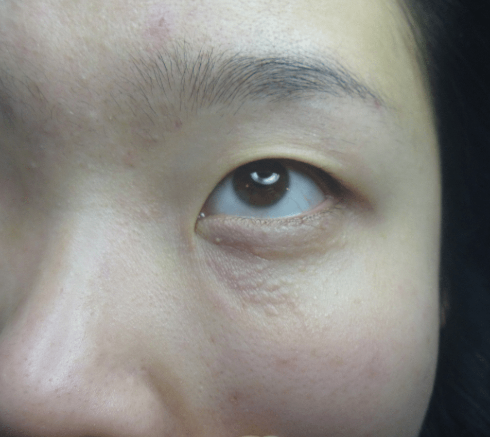 汗管瘤眼部怎么治?清华大学女生一次就把汗管瘤去除干净