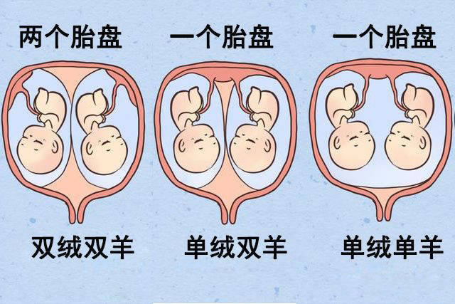 单绒单羊:一个绒毛膜,一个羊膜囊腔,就相当于是两个宝宝住在同一套