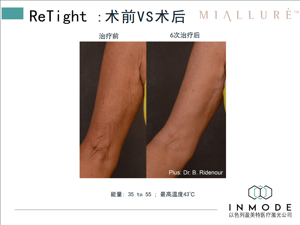 人群“隔空爆脂”,极速减肥黑科技-Miallure 钻石超塑来啦!