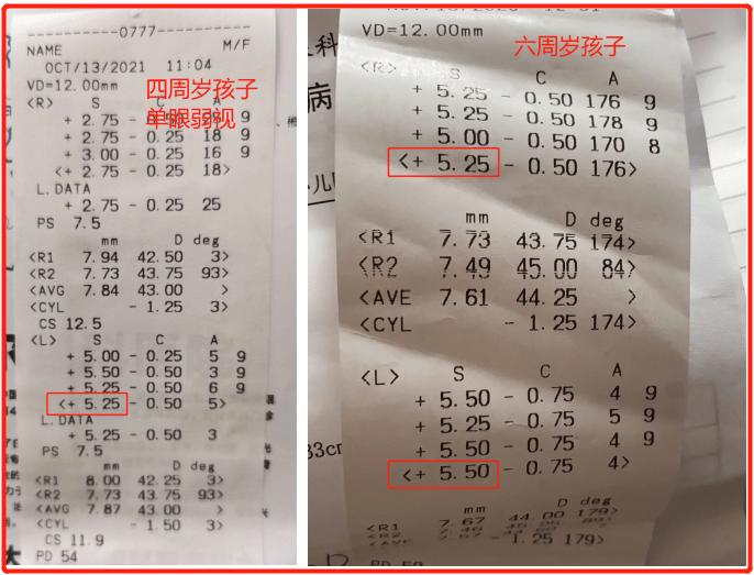 原創遠視案例解析孩子遠視要辯證看遠視儲備和短眼軸遠視要分清