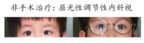 视觉|斜视的治疗方法有哪些?术后需要视觉训练吗?武汉普瑞眼科医院林珊解答