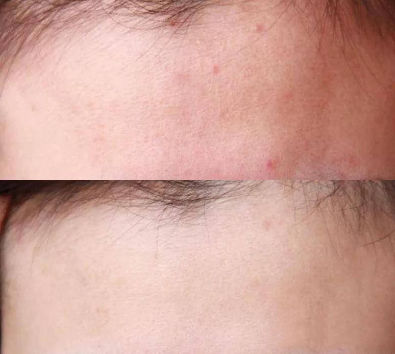 什么毛孔粗大怎么改善?