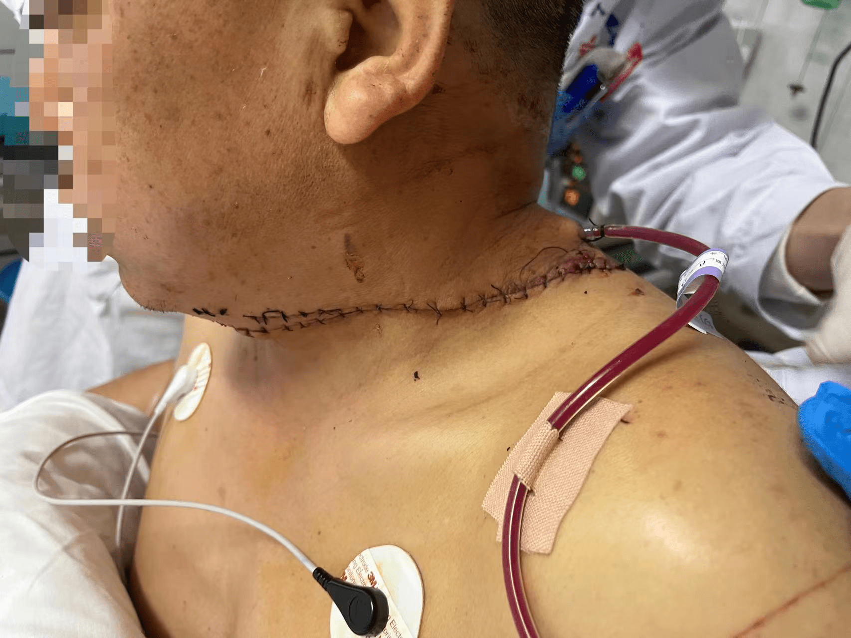 电锯惊魂湖南宁乡一男子电锯伐木惨遭割颈宁乡市人民医院上演生死竞速