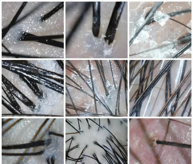 如果想了解更详细的头皮健康状况,可以去专业的养发馆进行专业的仪器