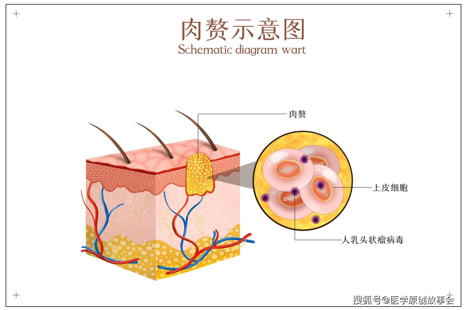 原創皮膚上長出一個個小肉球是怎麼回事可以摳掉嗎如何處理