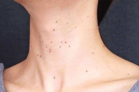 身体出现2种红点不能抠多半是感染hpv小心长满全身