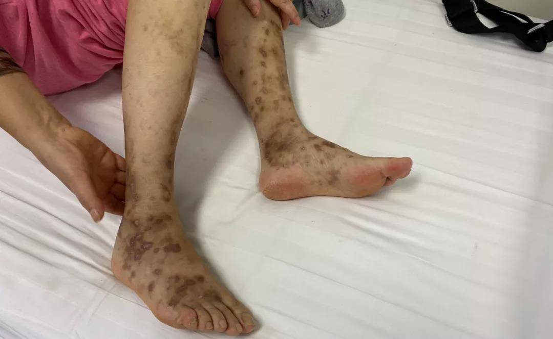 针灸|安军明主任医师针灸治疗血管炎合并周围神经病变一则