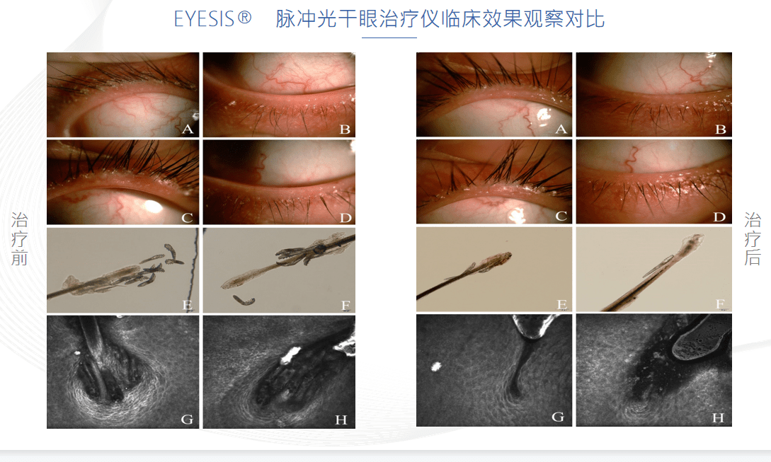 强脉冲光ipl治疗干眼效果好不好