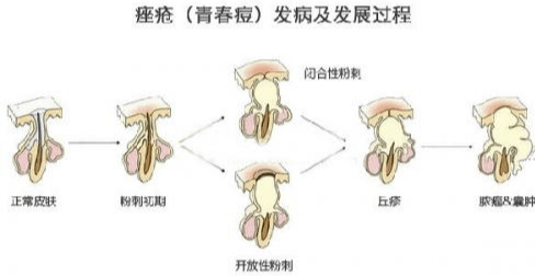 化妆品祛痘养肤找馨漫之舍，馨漫之舍让你没烦恼