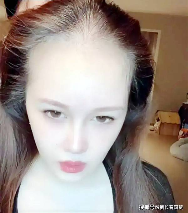 赵本山女儿无美颜近照吓坏网友,面色苍白脱发严重酷似"裘千尺"