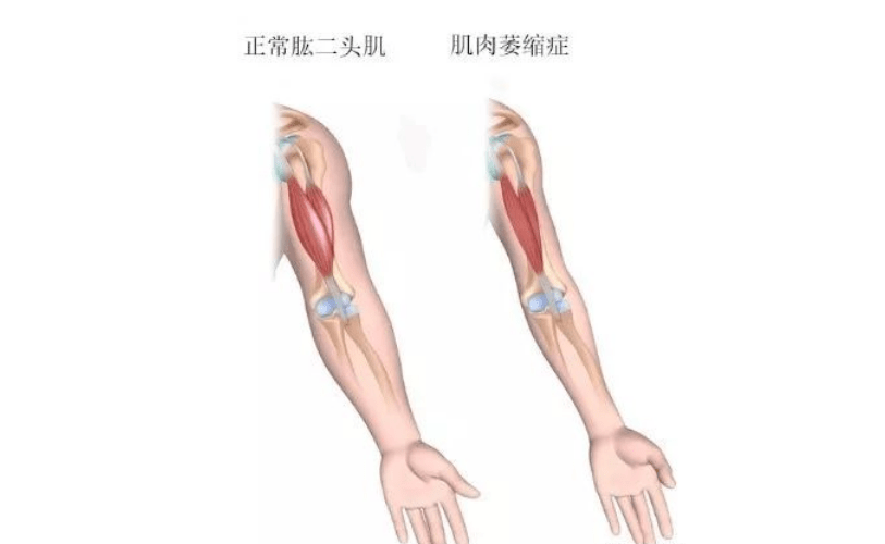 症状|肌肉萎缩发作早期信号有哪些、不同类型发作症状相同吗？