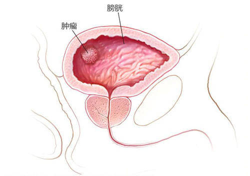 女性尿道癌的症状图片图片