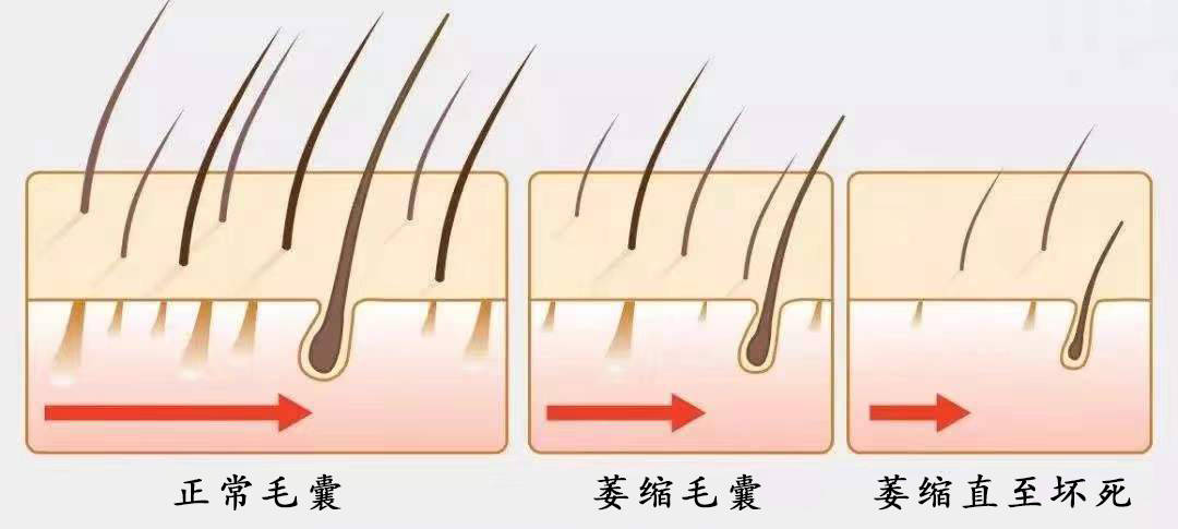 健康的毛囊呈旋渦狀,表面很乾淨,沒有明顯的堆積物,是一