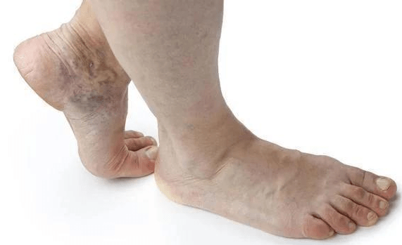 症状|糖尿病患者身体出现这6大症状，李爱国主任提醒可能是糖尿病肾病来了，别忽视!