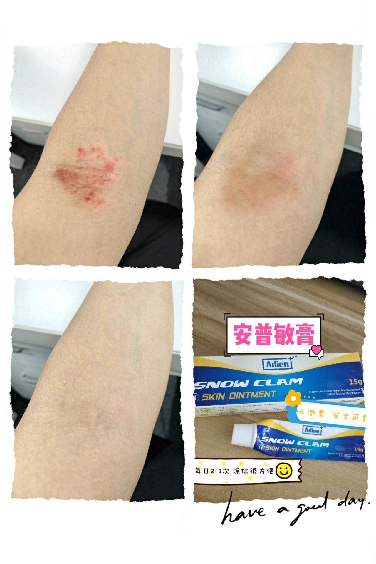 湿疹应该怎么办